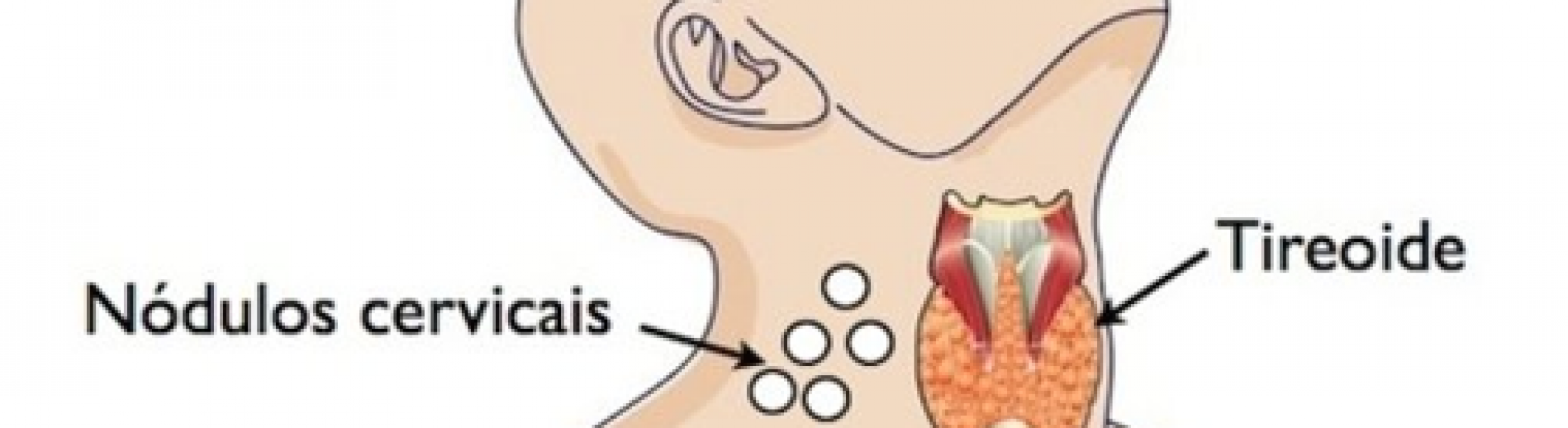 Cirurgia de tireoide (Tireoidectomia) Como é feita, principais tipos e